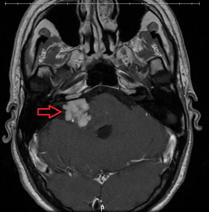 A medical diagnostic image showing a red arrow pointing to a white mass in a brain.
