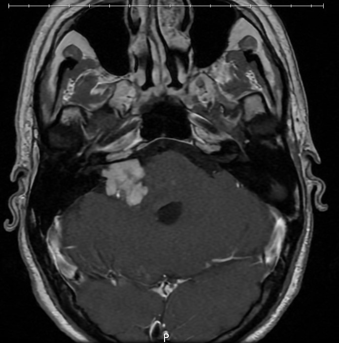 A medical diagnostic image showing a white mass in a person's brain.